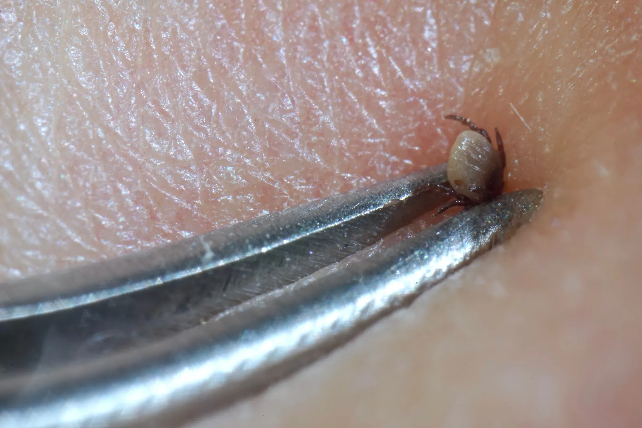 Tick Removal